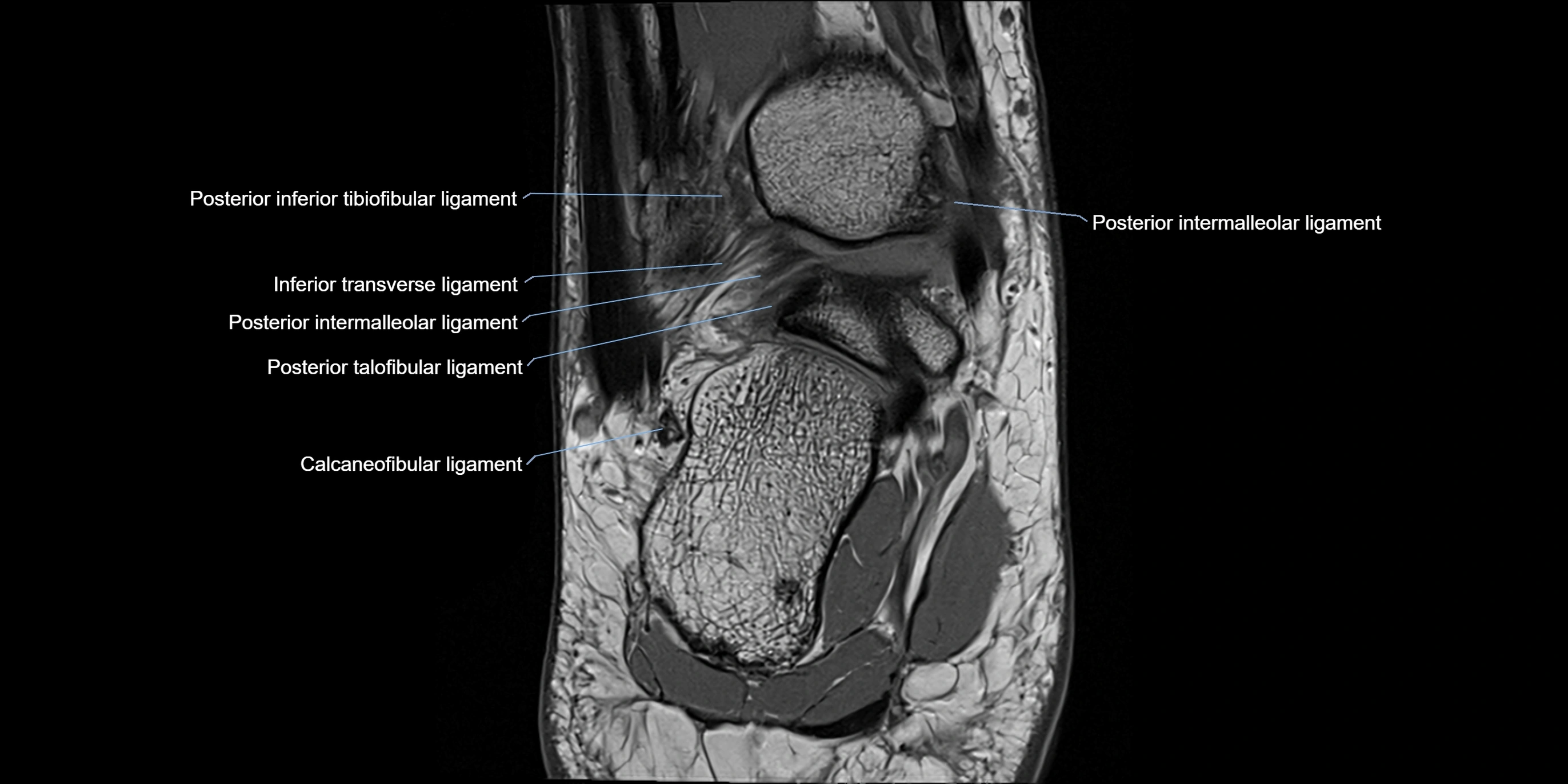 MRI Ankle coronal ligaments cross sectional anatomy 3T  radiology  image-img-00001-00018.webp